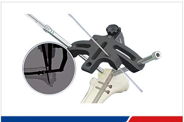 PEEK杆架用于髓内钉手术